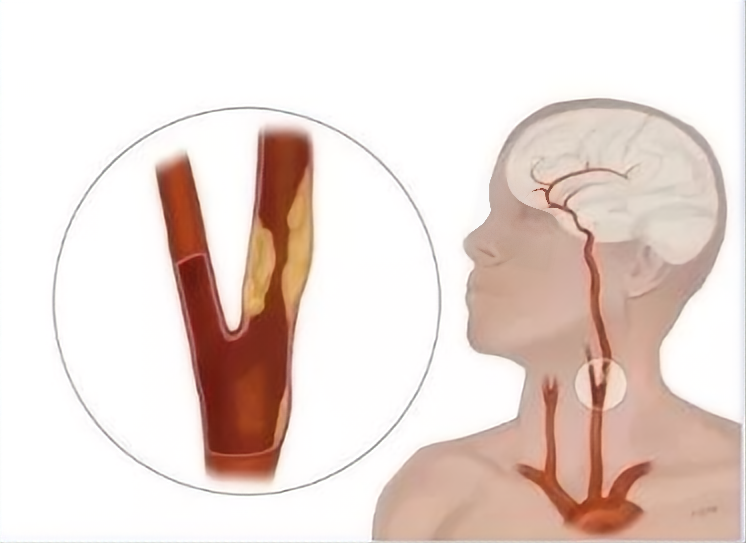 超千万中国人体检结果：两成有颈动脉斑块
